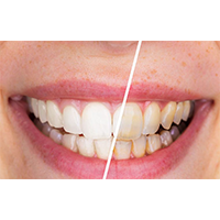 teeth polishing in hinjewadi pune